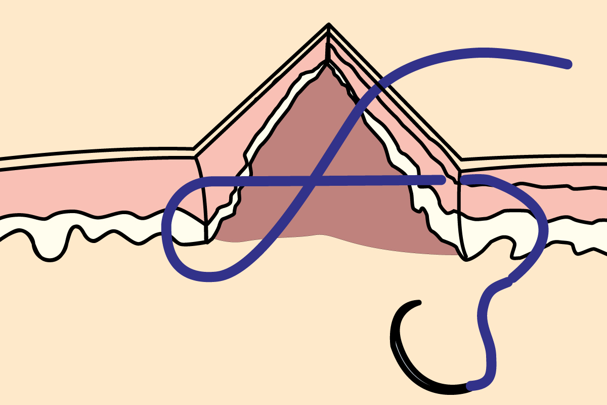 Common Suture Patterns: Simple Interrupted Intradermal Sutures