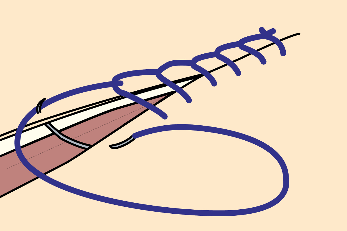 Common Suture Patterns: Ford Interlocking Sutures (Reverdin - Blanket Stitch - Lock Stitch)