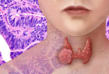New Thyroid Cancer Test is Faster and More Accurate