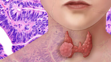 New Thyroid Cancer Test is Faster and More Accurate