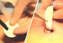 Very Good Technique: Umbilical Hernia Repair