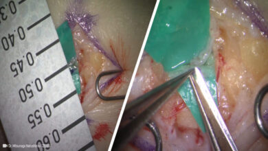Microsurgical Lymphovenous Anastomosis for Treatment of Lymphedema