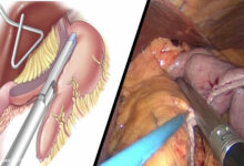 Bariatric (Obesity) Surgery: Laparoscopic Sleeve Gastrectomy (LSG)
