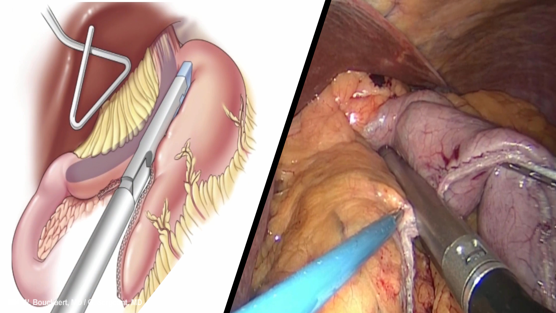 Bariatric (Obesity) Surgery: Laparoscopic Sleeve Gastrectomy (LSG)