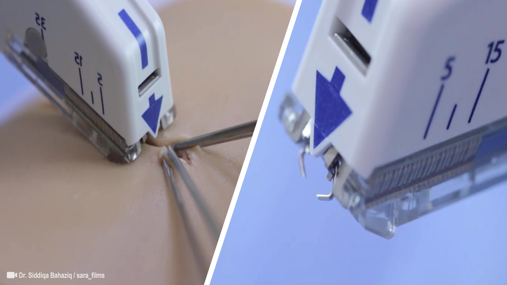 Surgical Skin Stapler: Take a Close Look at How It Works?