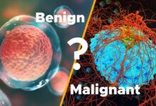 What is the Difference Between Tumor and a Cancer?