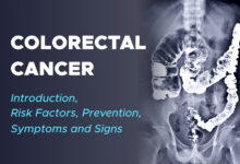 Colorectal Cancer Introduction, Risk Factors, Prevention, Symptoms and Signs