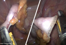 This Pediatric Stapler that Can Fit into Tight Spaces and Reducing Port Size from 12mm to 5mm