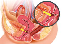 Vesicovaginal Fistula (VVF) Treatment