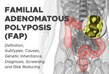 Familial Adenomatous Polyposis (FAP)
