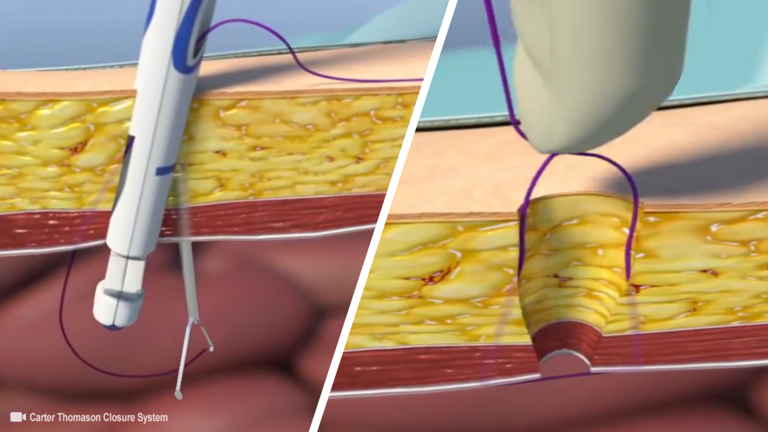 Trocar Site Hernia (Port Site Hernia) Definition, Classification