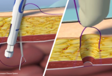 trocar site hernia or port site hernia