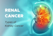 Renal Cancer: Types of Kidney Cancer