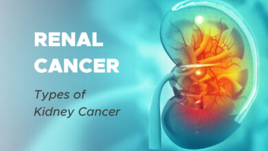 Renal Cancer: Types of Kidney Cancer
