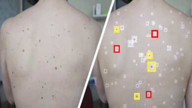 An Artificial Intelligence Tool Can Help Detect Suspicious Skin Lesions on Smartphone Photos
