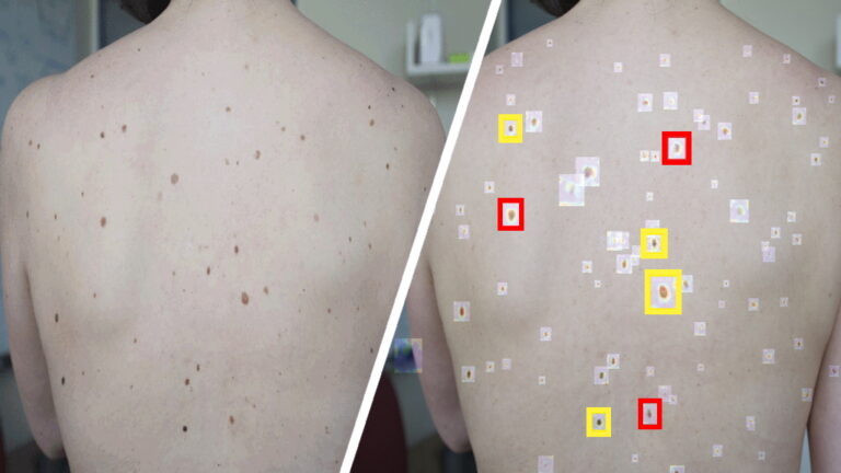 An Artificial Intelligence Tool Can Help Detect Suspicious Skin Lesions ...