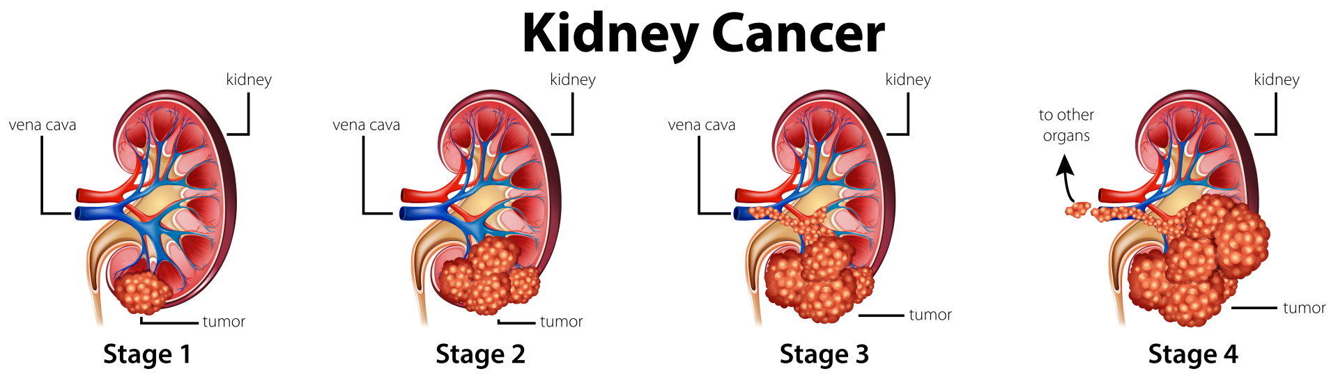 Kidney cancer, also called renal cancer, is one of the most common types of cancer in the world.