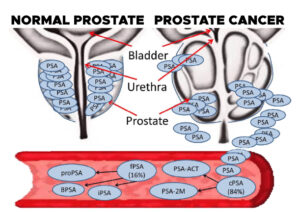 Prostate-specific antigen (PSA) can be found in people with prostate cancer.