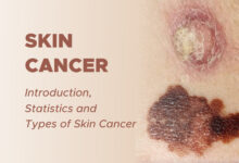 Skin Cancer: Introduction, Statistics and Types of Skin Cancer