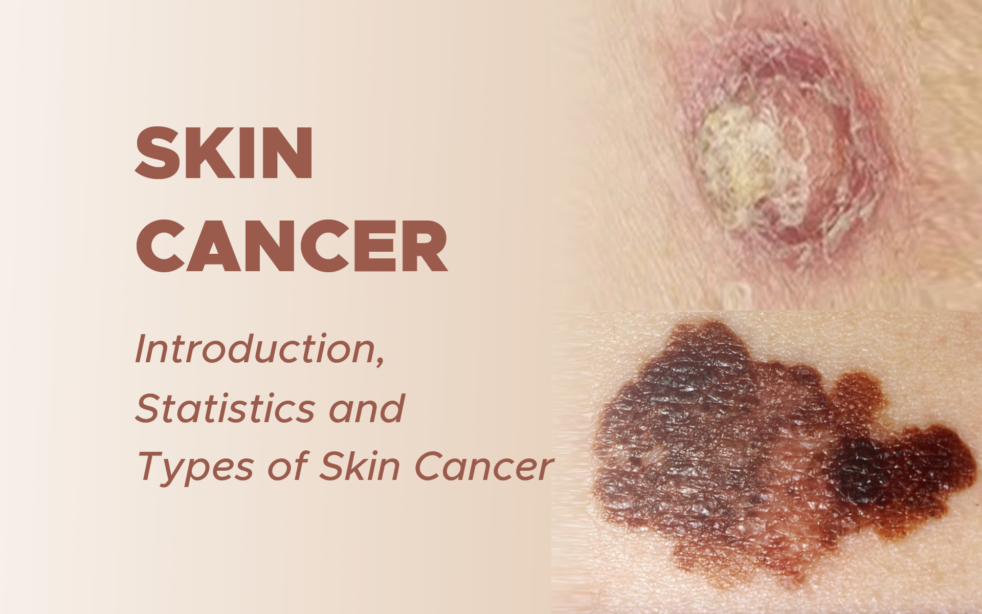 Skin Cancer: Introduction, Statistics and Types of Skin Cancer