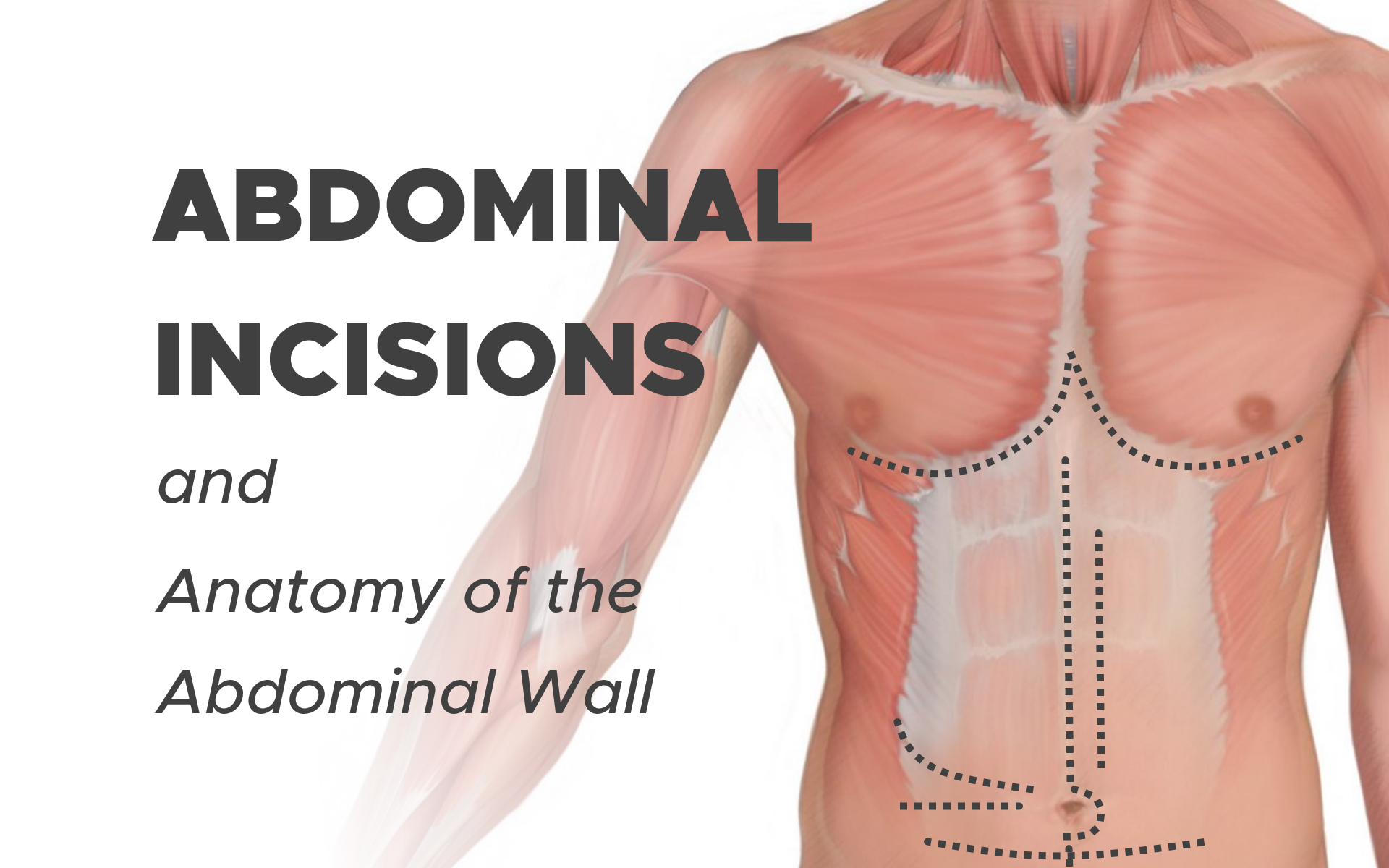 Types of Abdominal Incisions: Midline, Paramedian, Transverse and Oblique Incisions