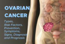 Ovarian Cancer: Types, Risk Factors, Prevention, Symptoms, Signs, Diagnosis and Prognosis