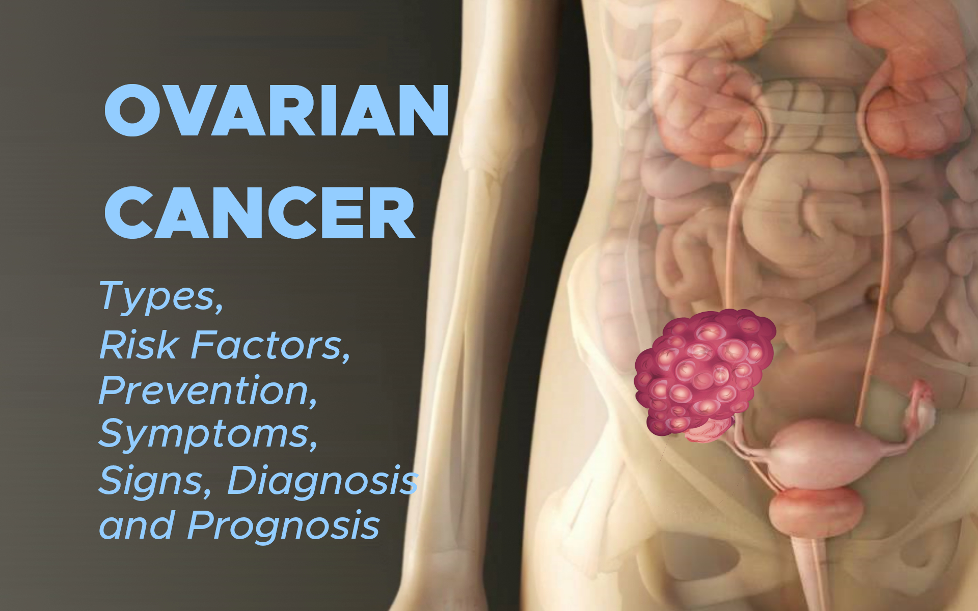 Ovarian Cancer: Types, Risk Factors, Prevention, Symptoms, Signs, Diagnosis and Prognosis