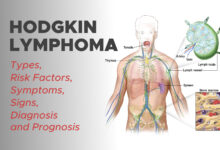 Hodgkin Lymphoma: Types, Risk Factors, Symptoms, Signs, Diagnosis and Prognosis