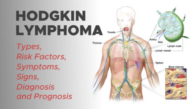 Hodgkin Lymphoma: Types, Risk Factors, Symptoms, Signs, Diagnosis and Prognosis