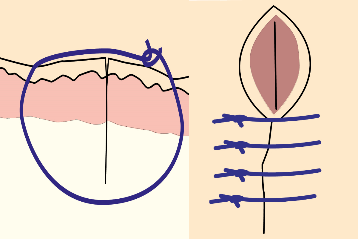 Common Suture Patterns: Simple Interrupted Sutures
