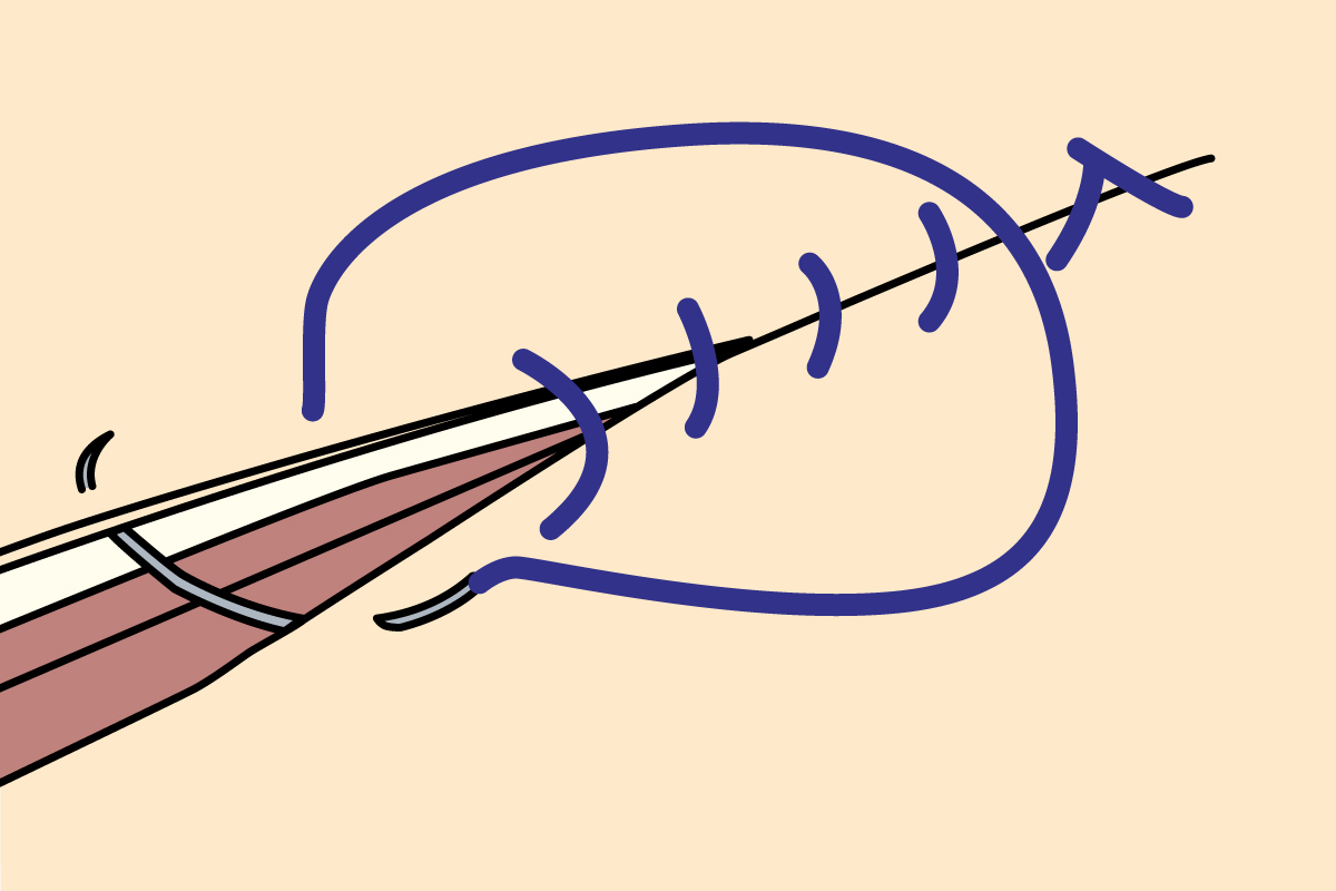 Common Suture Patterns: Simple Continuous Sutures