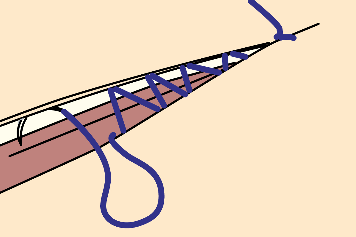 Common Suture Patterns: Continuous Intradermal Sutures