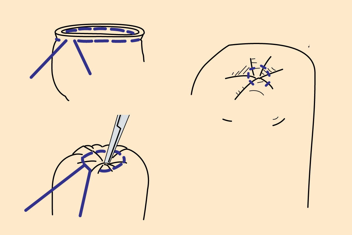 Common Suture Patterns: Purse String Sutures