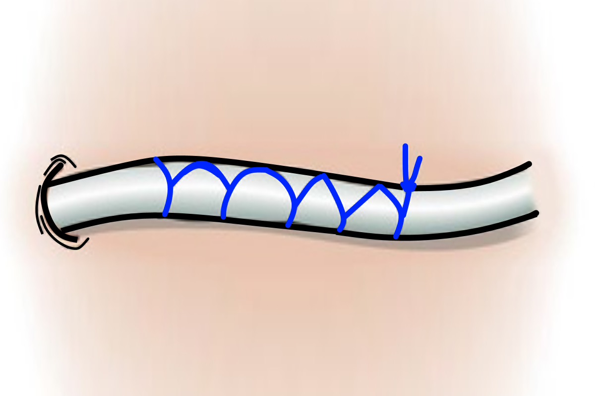 Common Suture Patterns: Chinese Finger Trap