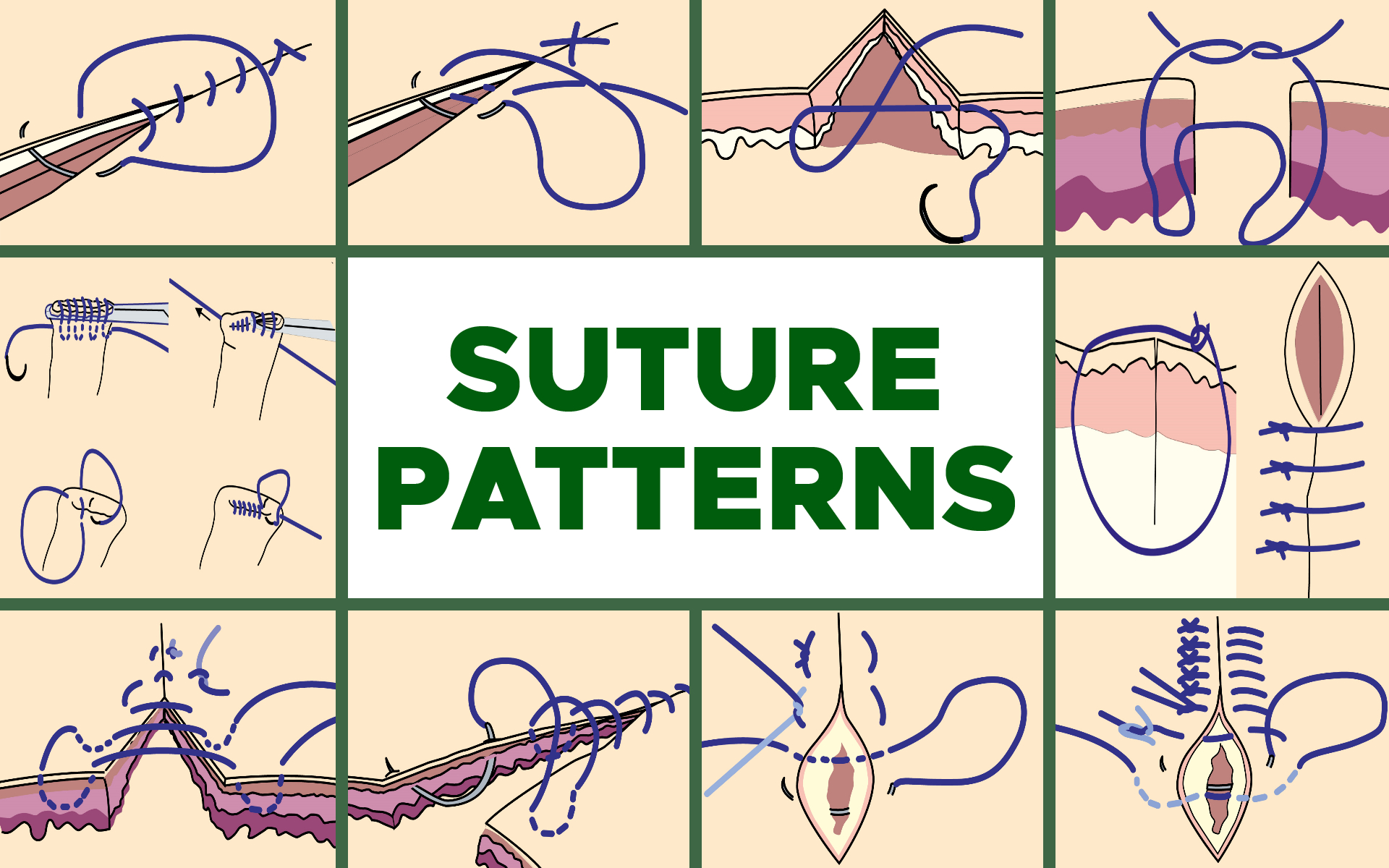 Common Suture Patterns: Interrupted, Continuous, Appositional, Inverting, Tension and Others