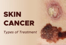 Treatment of Skin Cancer (Non-Melanoma)