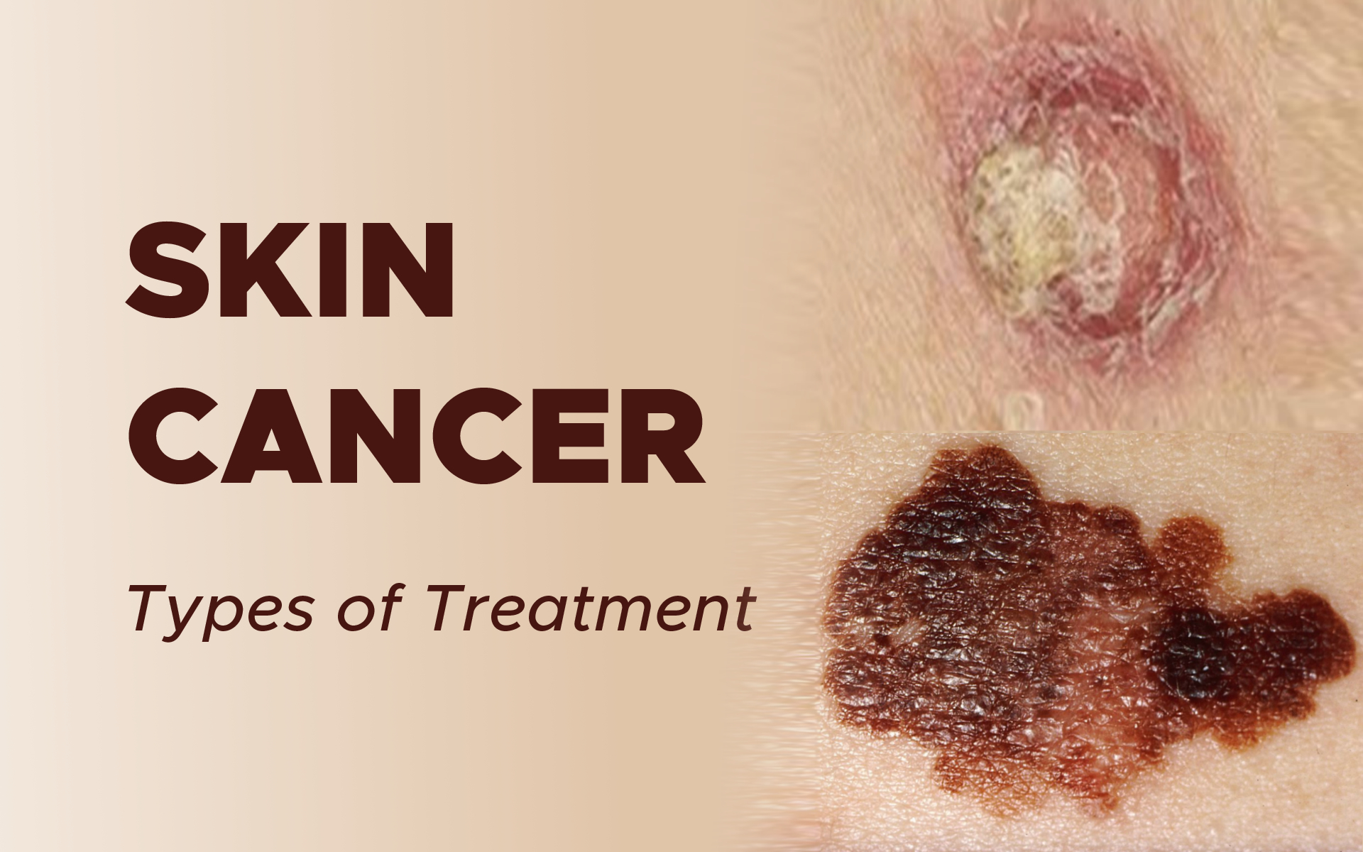 Treatment of Skin Cancer (Non-Melanoma)