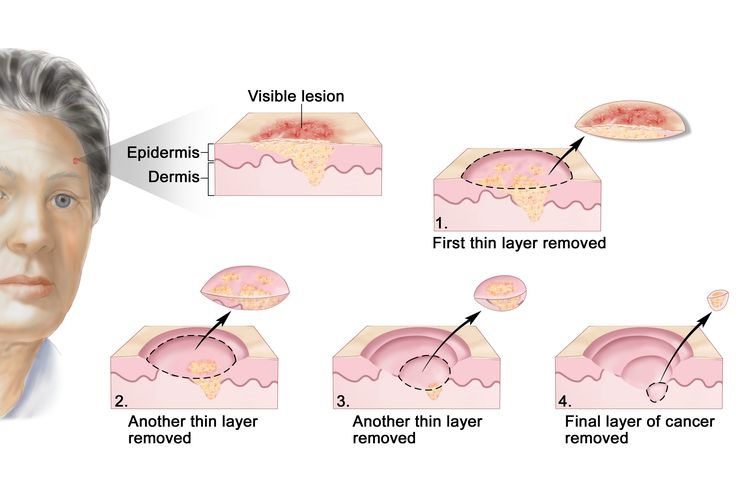 treatment of skin cancer (non-melanoma)
