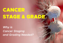 Cancer Grade vs. Cancer Stage