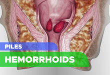 Hemorrhoids (Piles): Symptoms, Causes, Risk Factors, Prevention, Complication and Treatment