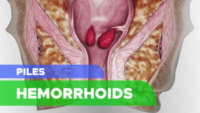 Hemorrhoids (Piles): Symptoms, Causes, Risk Factors, Prevention, Complication and Treatment
