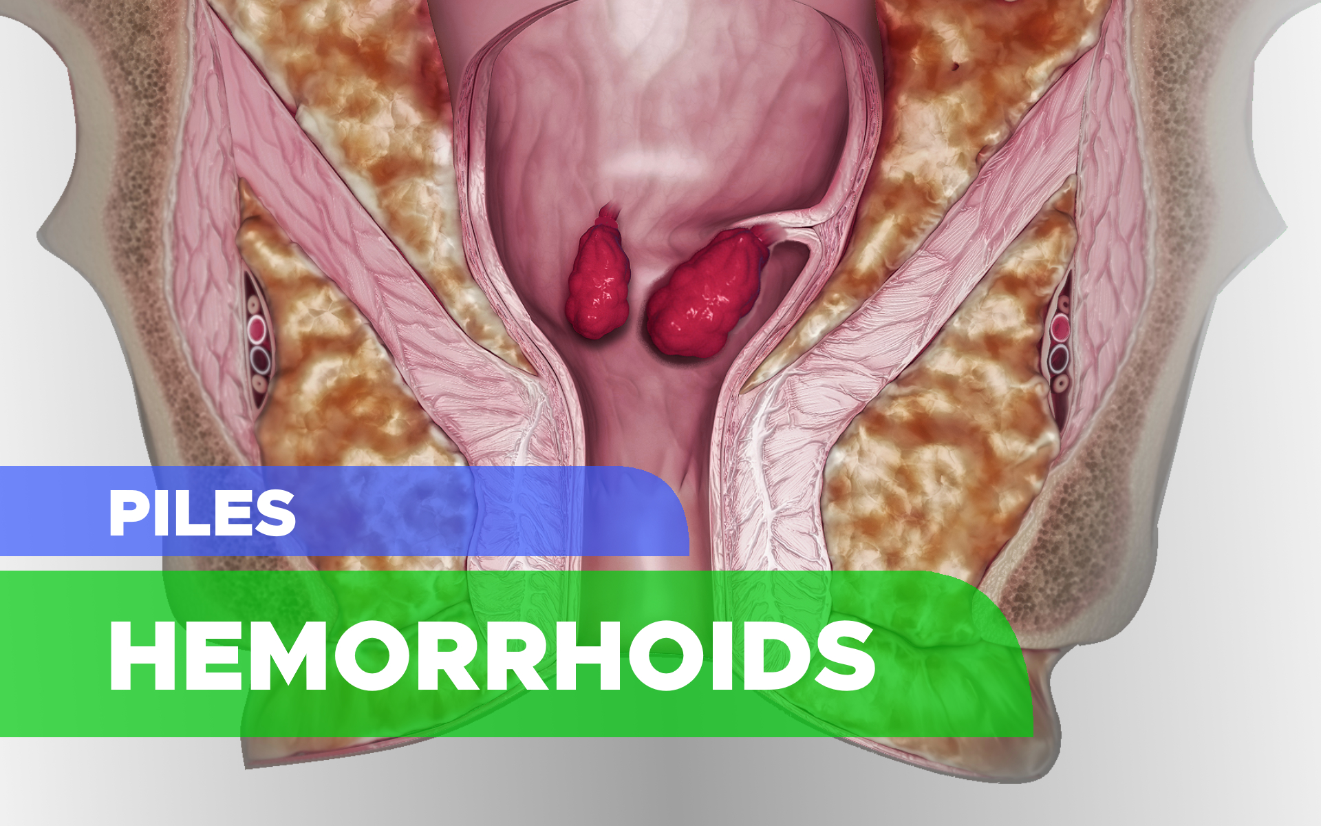 Hemorrhoids (Piles): Symptoms, Causes, Risk Factors, Prevention, Complication and Treatment