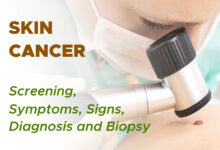 Non Melanoma Skin Cancer: Screening, Symptoms, Signs, Diagnosis and Biopsy