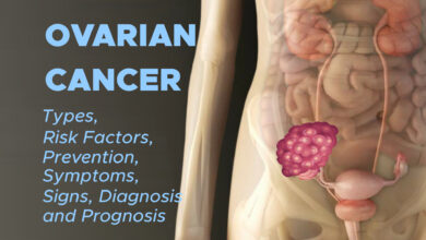 Ovarian Cancer: Types, Risk Factors, Prevention, Symptoms, Signs, Diagnosis and Prognosis