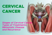 Stages of Cervical Cancer, Surgery, Radiation Therapy, Chemotherapy, Targeted Therapy, Immunotherapy, Metastatic Cervical Cancer and Recurrence
