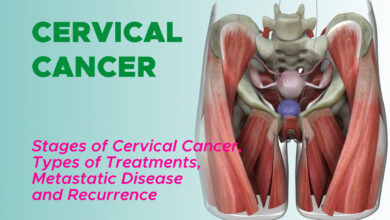 Stages of Cervical Cancer, Surgery, Radiation Therapy, Chemotherapy, Targeted Therapy, Immunotherapy, Metastatic Cervical Cancer and Recurrence