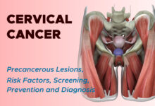 Cervical Cancer: Risk Factors, Screening, Prevention and Diagnosis