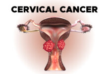 Stages of Cervical Cancer, Surgery, Radiation Therapy, Chemotherapy, Targeted Therapy, Immunotherapy, Metastatic Cervical Cancer and Recurrence