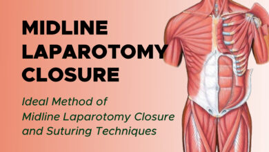 Continuous Midline Laparotomy Closure: Suture Techniques