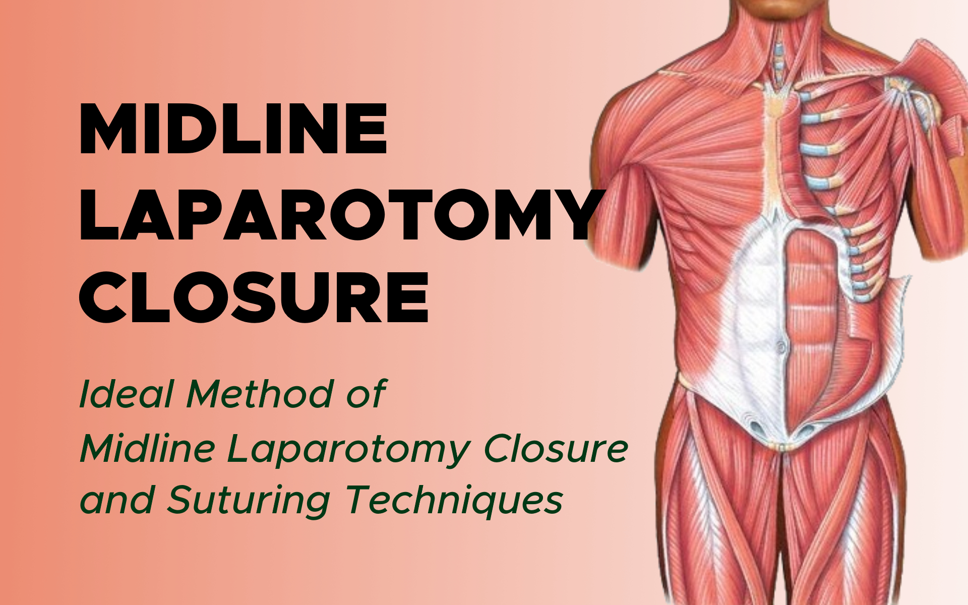 Continuous Midline Laparotomy Closure: Suture Techniques